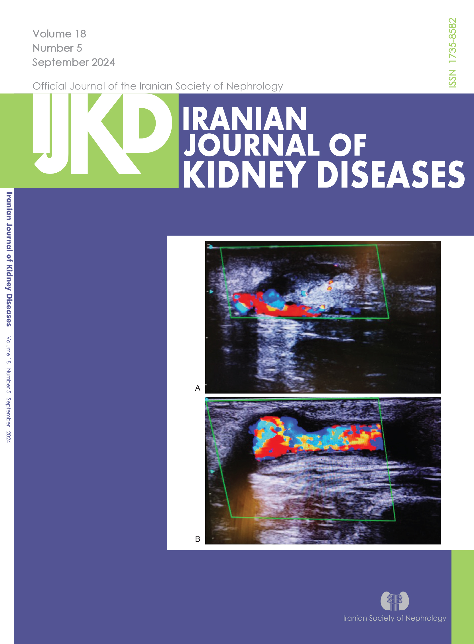 Ultrasound Images of Post-thrombolysis AVF (A) and Post-PTA AVF, after Thrombolysis (B)